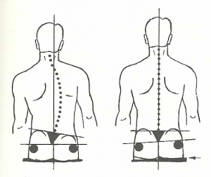 Tegning som viser vanlige kjennetegn ved skoliose.