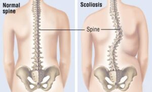 Her ser vi sammenlikning av to ryggrader, en som er vanlig og en med skoliose.